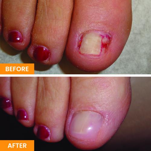 Before and After Nail Restoration Specialist in Orange, CA Before and After Nail Restoration Specialist in Orange, CA