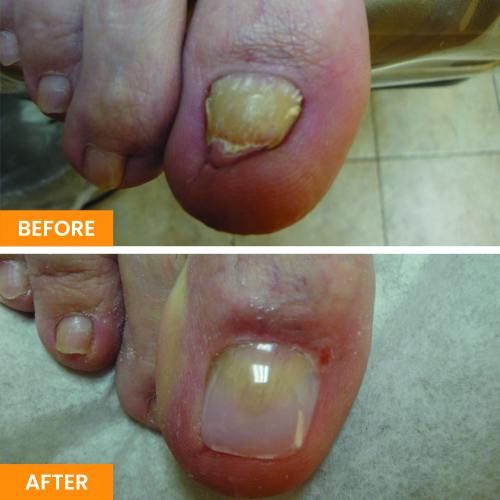 Before and After Nail Restoration Specialist in Orange, CA Before and After Nail Restoration Specialist in Orange, CA
