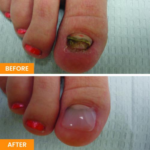 Before and After Nail Restoration Specialist in Orange, CA Before and After Nail Restoration Specialist in Orange, CA