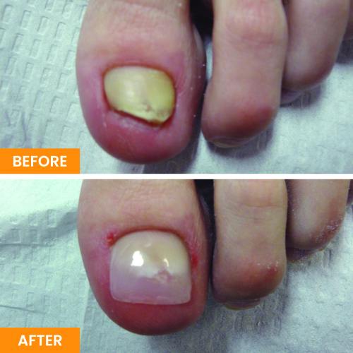 Before and After Nail Restoration Specialist in Orange, CA Before and After Nail Restoration Specialist in Orange, CA
