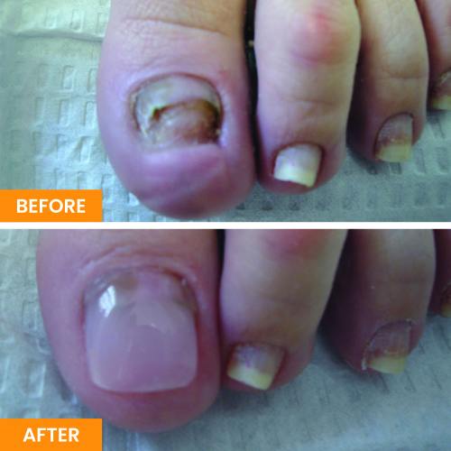 Before and After Nail Restoration Specialist in Orange, CA Before and After Nail Restoration Specialist in Orange, CA