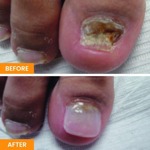Before and After Nail Restoration Specialist in Orange, CA Before and After Nail Restoration Specialist in Orange, CA
