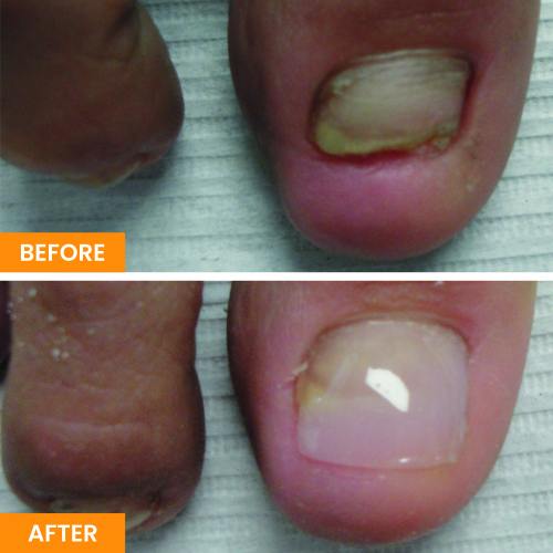 Before and After Nail Restoration Specialist in Orange, CA Before and After Nail Restoration Specialist in Orange, CA