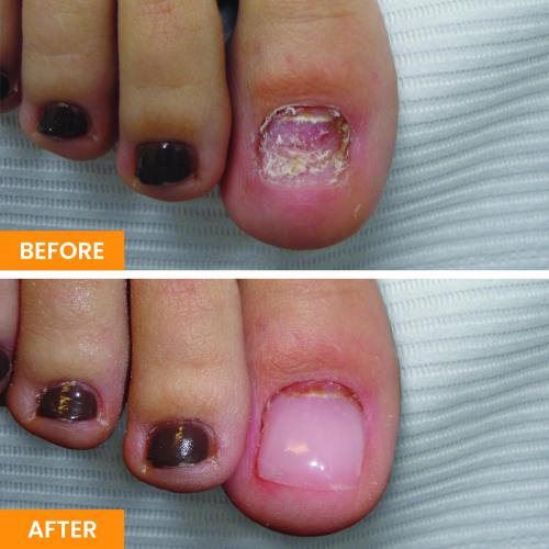 Before and After Nail Restoration Specialist in Orange, CA Before and After Nail Restoration Specialist in Orange, CA