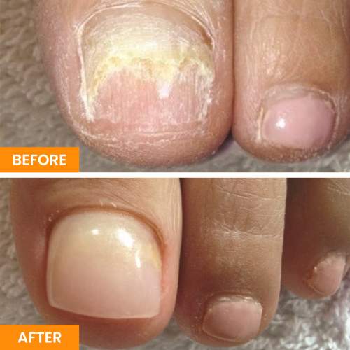 Before and After Nail Restoration Specialist in Orange, CA Before and After Nail Restoration Specialist in Orange, CA