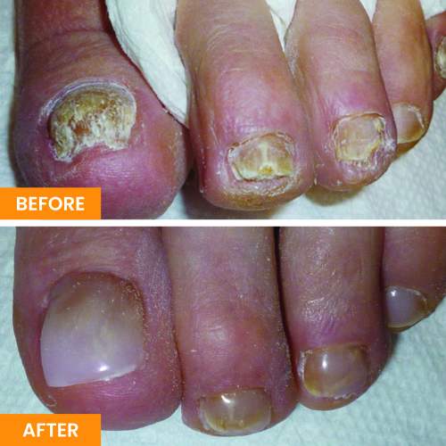 Before and After Nail Restoration Specialist in Orange, CA Before and After Nail Restoration Specialist in Orange, CA