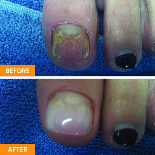 Before and After Nail Restoration Specialist in Orange, CA Before and After Nail Restoration Specialist in Orange, CA