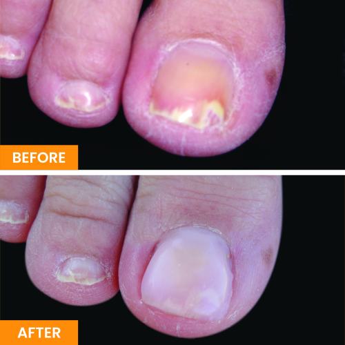 Before and After Nail Restoration Specialist in Orange, CA Before and After Nail Restoration Specialist in Orange, CA