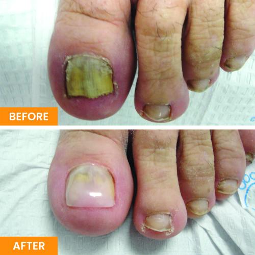 Before and After Nail Restoration Specialist in Orange, CA Before and After Nail Restoration Specialist in Orange, CA