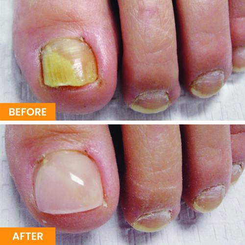 Before and After Nail Restoration Specialist in Orange, CA Before and After Nail Restoration Specialist in Orange, CA