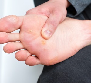 Calluses and Corns Treatment Near Me in Orange, CA