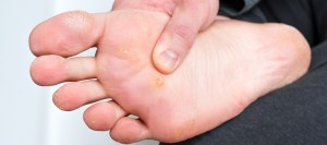 Foot Corns and Calluses Treatment Near Me in Orange, CA Foot Corns and Calluses Treatment Near Me in Orange, CA