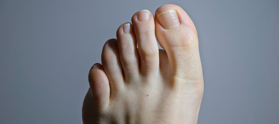 Ingrown Toenail Removal Specialist Near Me in Orange, CA Ingrown Toenail Removal Specialist Near Me in Orange, CA