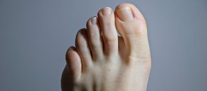 Ingrown Toenail Removal Specialist Near Me in Orange, CA Ingrown Toenail Removal Specialist Near Me in Orange, CA