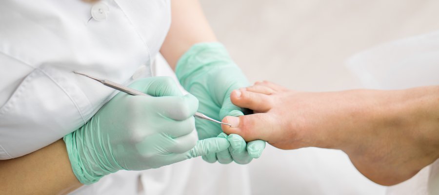 Benefits of Removing an Ingrown Toenail | Renew Podiatry Near Me in Orange, CA Benefits of Removing an Ingrown Toenail | Renew Podiatry Near Me in Orange, CA