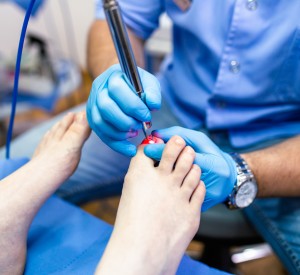 Laser Fungal Nail Treatment Near Me in Orange, CA