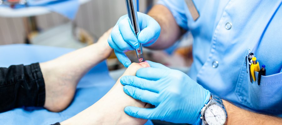 Factors Affecting the Cost of Laser Treatment for Toenail Fungus in Orange, CA Factors Affecting the Cost of Laser Treatment for Toenail Fungus in Orange, CA