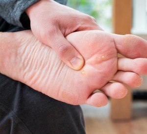 Swift Wart Treatment Near Me in Orange, CA
