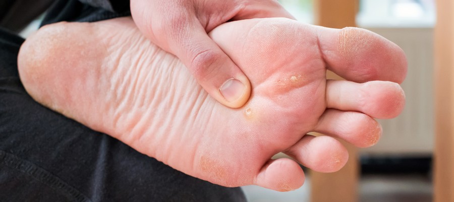 Swift Wart Treatment Specialist Near Me in Orange, CA Swift Wart Treatment Specialist Near Me in Orange, CA
