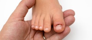 Ingrown Toenail Treatment Near Me in Orange, CA 