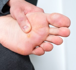 Warts Treatment Near Me in Orange, CA