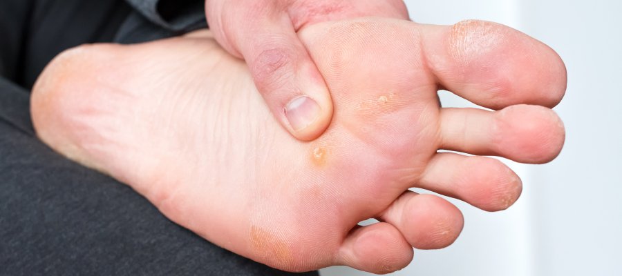 Foot Warts Treatment Near Me in Orange, CA Foot Warts Treatment Near Me in Orange, CA