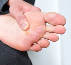 Warts Treatment Near Me in Orange, CA
