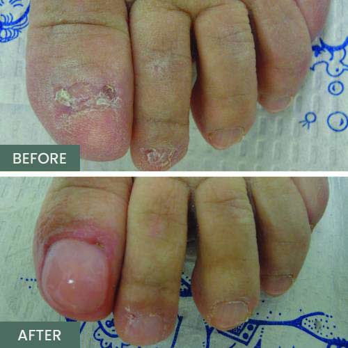 Nail Restoration Before and After in Orange, CA Nail Restoration Before and After in Orange, CA