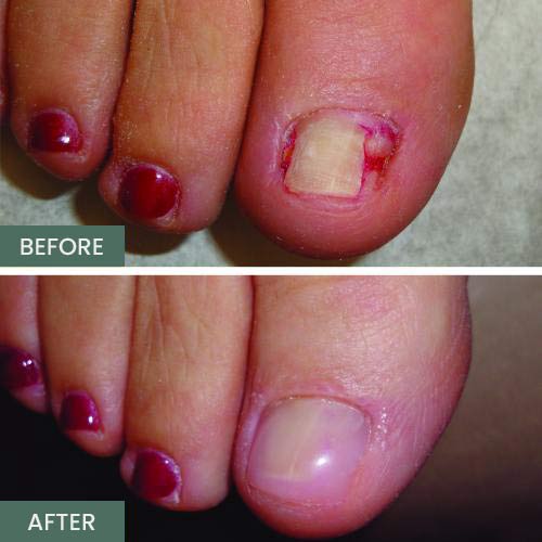 Nail Restoration Before and After in Orange, CA Nail Restoration Before and After in Orange, CA