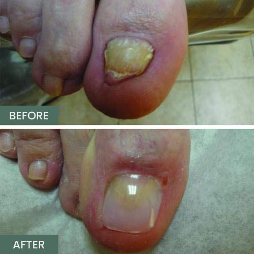 Nail Restoration Before and After in Orange, CA Nail Restoration Before and After in Orange, CA