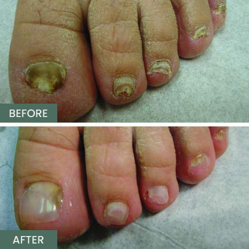 Nail Restoration Before and After in Orange, CA Nail Restoration Before and After in Orange, CA