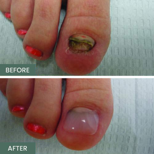 Nail Restoration Before and After in Orange, CA Nail Restoration Before and After in Orange, CA