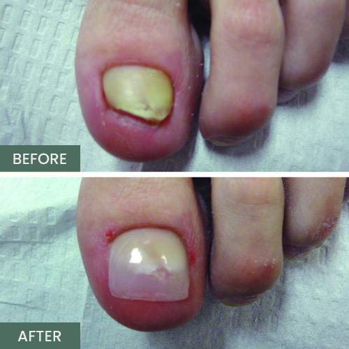 Nail Restoration Before and After in Orange, CA Nail Restoration Before and After in Orange, CA