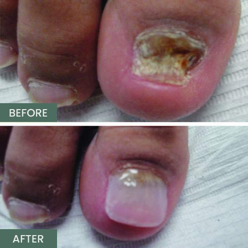 Nail Restoration Before and After in Orange, CA Nail Restoration Before and After in Orange, CA