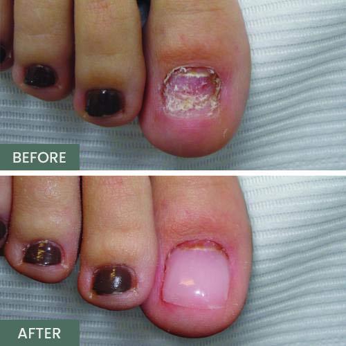 Nail Restoration Before and After in Orange, CA Nail Restoration Before and After in Orange, CA