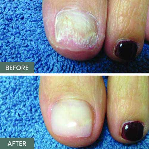 Nail Restoration Before and After in Orange, CA Nail Restoration Before and After in Orange, CA