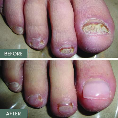 Before and After Nail Restoration Specialist in Orange, CA Before and After Nail Restoration Specialist in Orange, CA