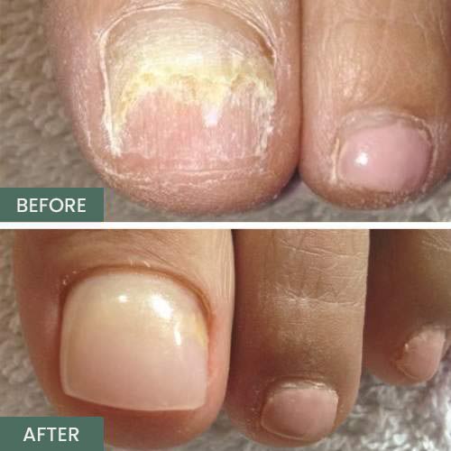 Nail Restoration Before and After in Orange, CA Nail Restoration Before and After in Orange, CA