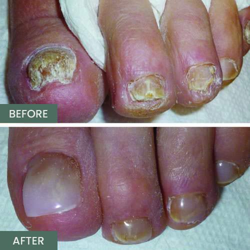 Nail Restoration Before and After in Orange, CA Nail Restoration Before and After in Orange, CA