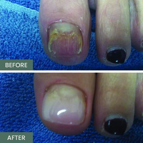 Nail Restoration Before and After in Orange, CA Nail Restoration Before and After in Orange, CA