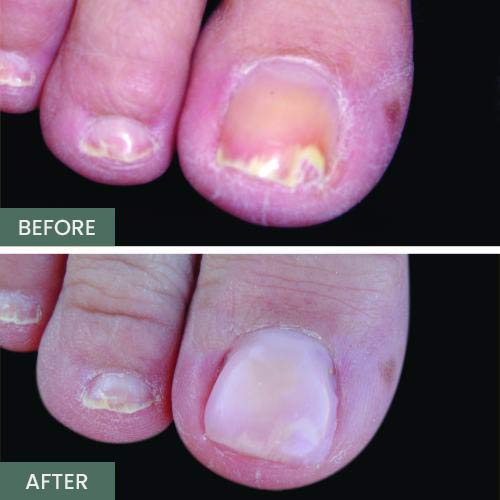 Nail Restoration Before and After in Orange, CA Nail Restoration Before and After in Orange, CA
