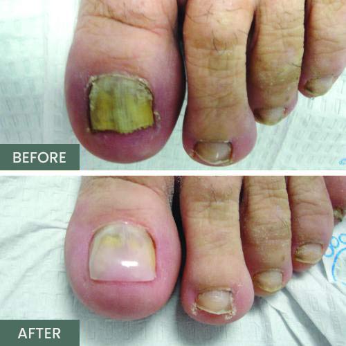 Nail Restoration Before and After in Orange, CA Nail Restoration Before and After in Orange, CA