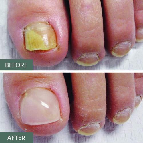 Nail Restoration Before and After in Orange, CA Nail Restoration Before and After in Orange, CA